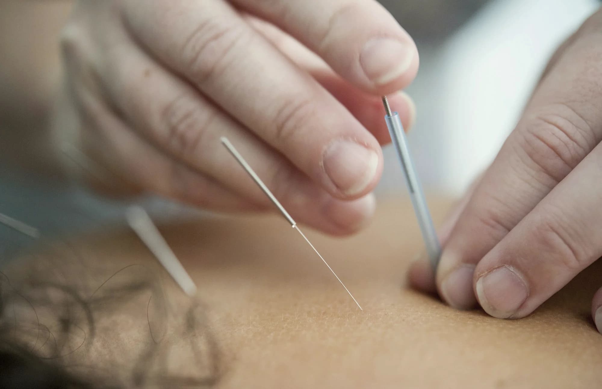 Tanke igle za dry needling u mišiću.
